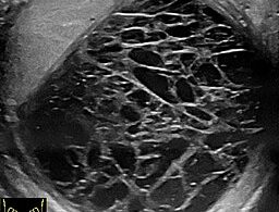 USG moszny wykazuje krwiak