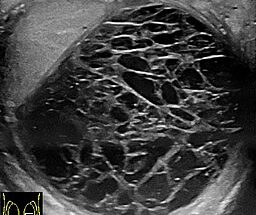 USG moszny wykazuje krwiak