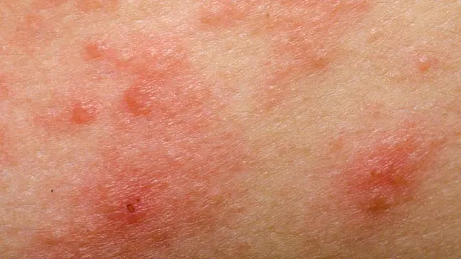 Allergic_Eczema