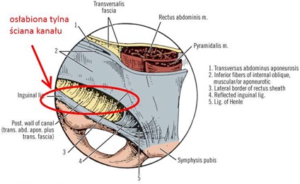 IVc