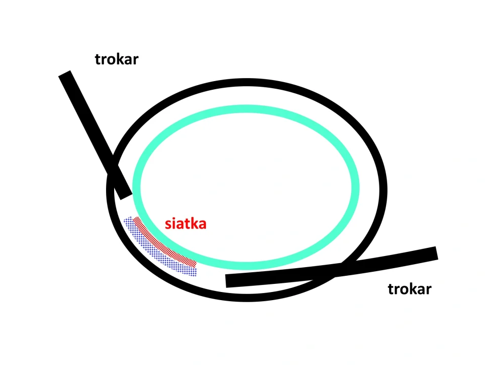 TEP