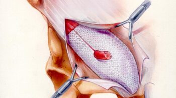 Trabucco przepuklina schemat