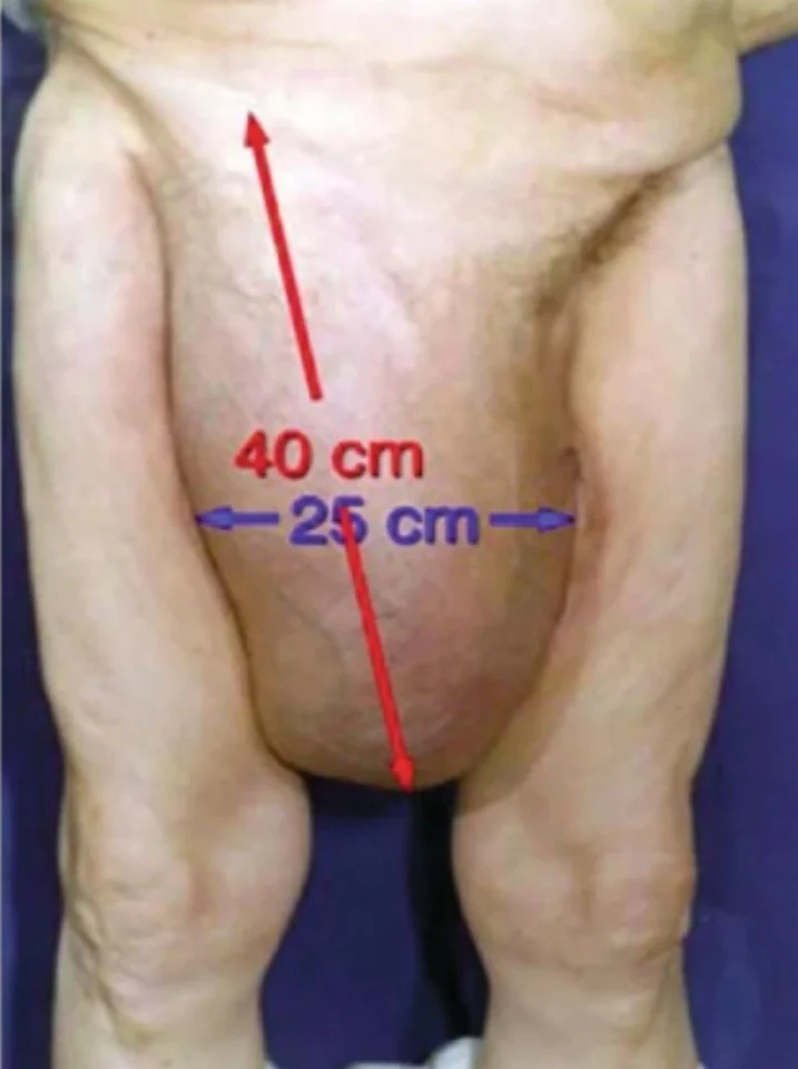 large hernia 1