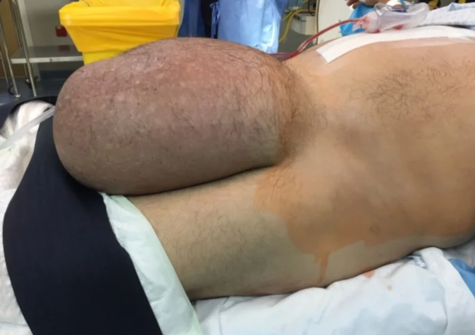 large hernia 2