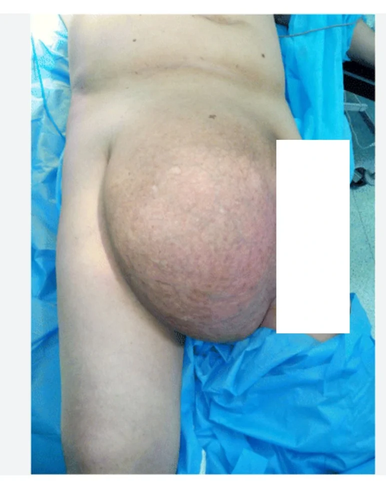 large hernia 3