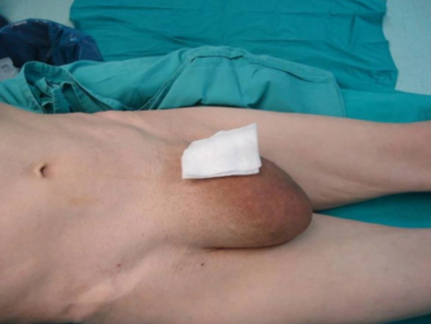 large hernia 4