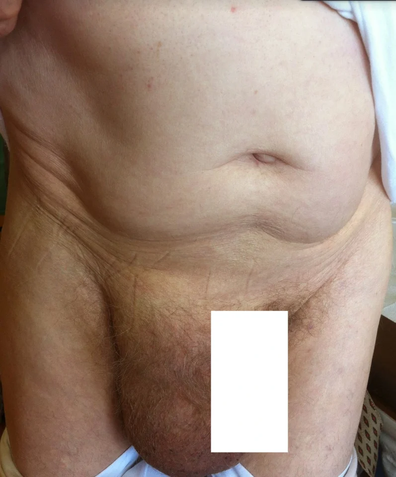large hernia 5