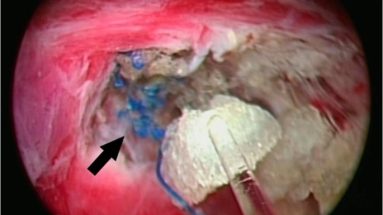 erozja siatki do pęcherza moczowego