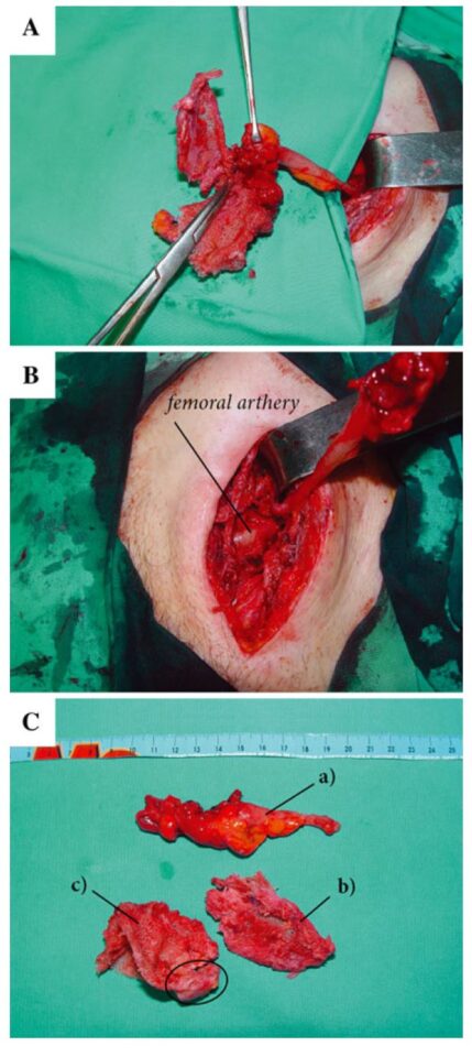 przetoka do wyrostka 2