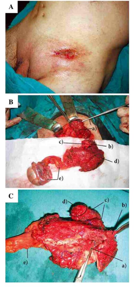 przetoka do wyrostka 3