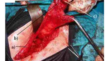 przetoka od siatki przepuklinowej do wyrostka