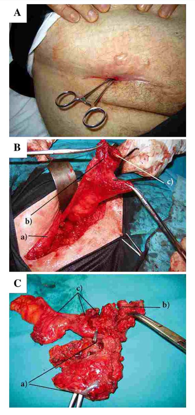 Powikłania przy siatce przepuklinowej