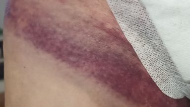 wybroczyny w pachwinie po operacji przepukliny