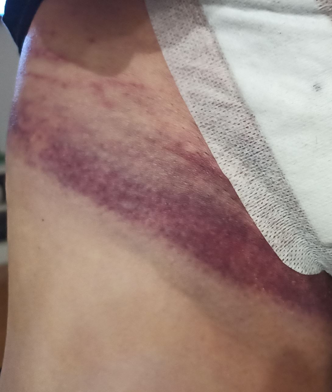 Wyborczyny wokół rany operacyjnej